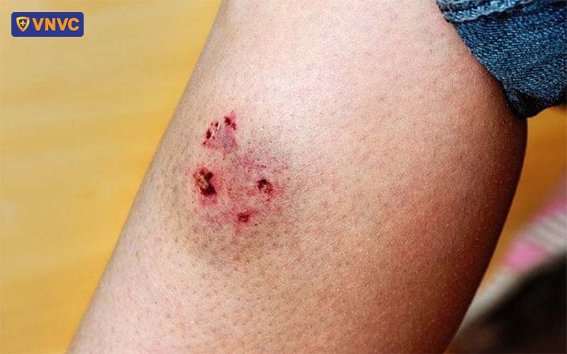 bị chó cắn ở chi