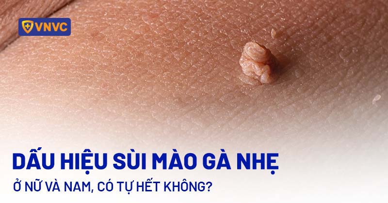 sùi mào gà nhẹ