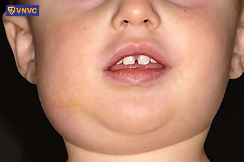 trẻ mắc quai bị