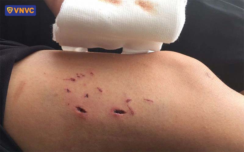 vết chó cắn ở chi
