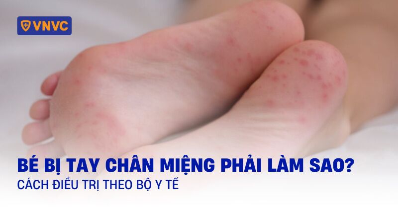 bé bị tay chân miệng phải làm sao
