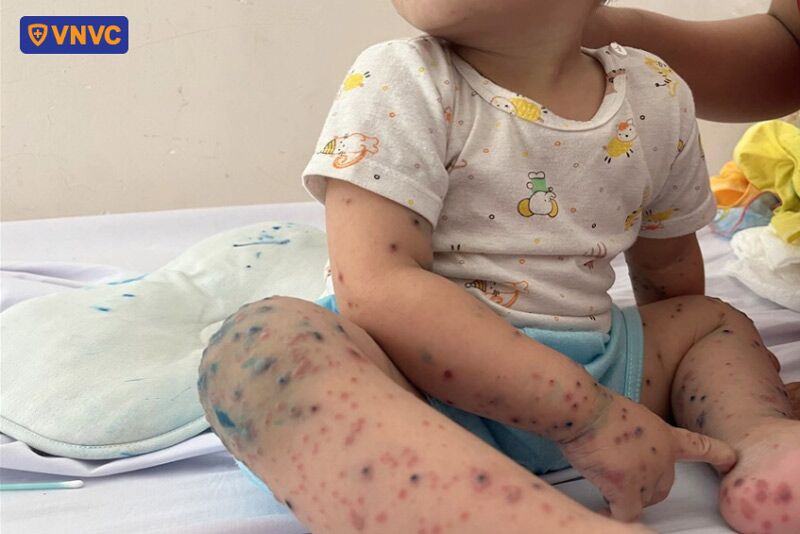 trẻ nhỏ bị tay chân miệng